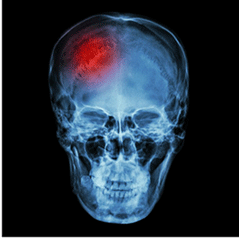 fall-and-brain-injury