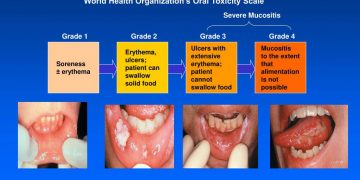 Cancer Treatments, Mucositis & Mouthwash